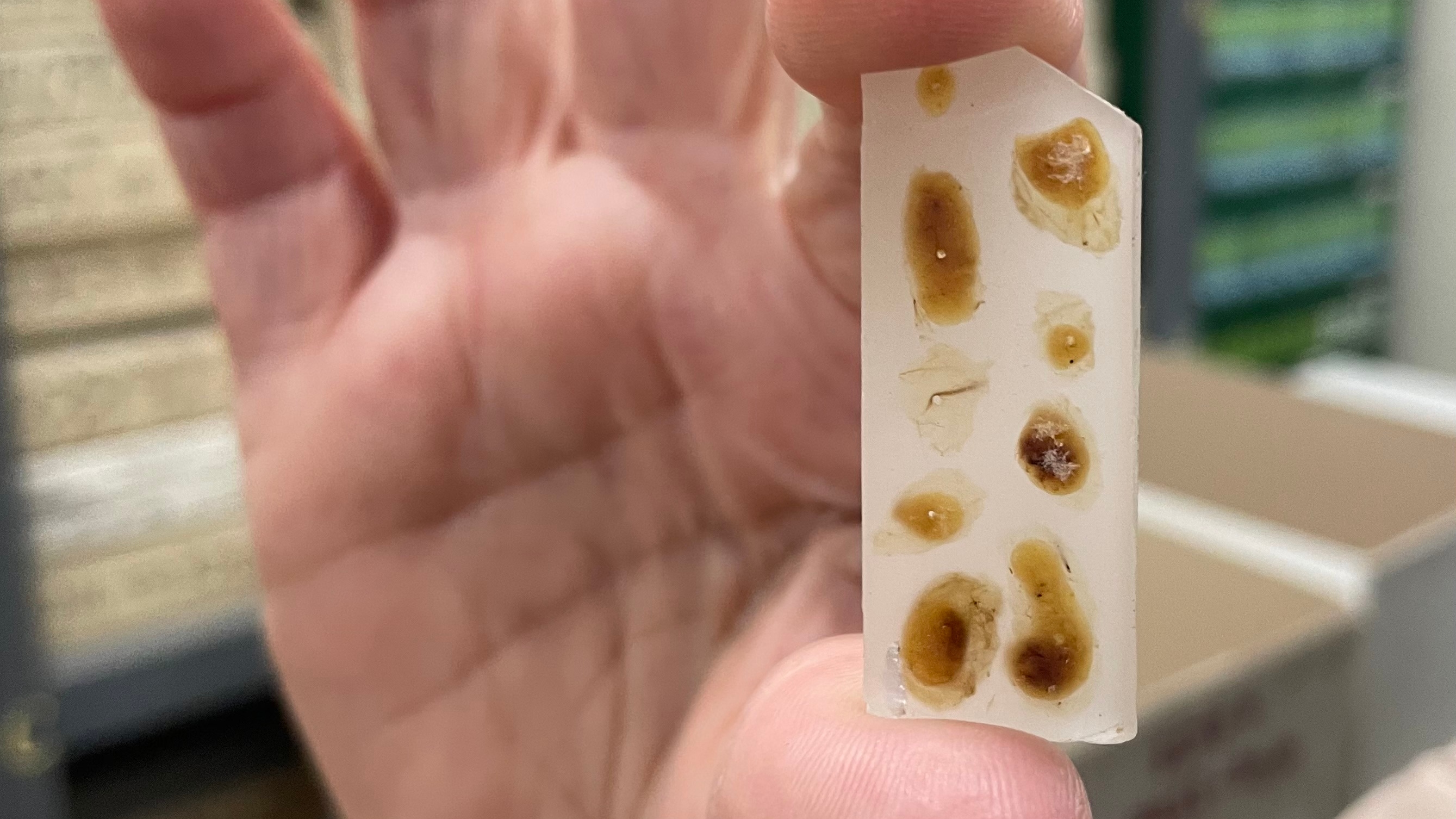 A biopsy sample set in wax A hand holding a bowel cancer biopsy sample from the 1950s, set in wax