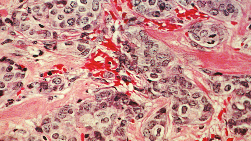 A histological slide of cancerous breast tissue. (photo: Dr Cecil Fox/National Cancer Institute