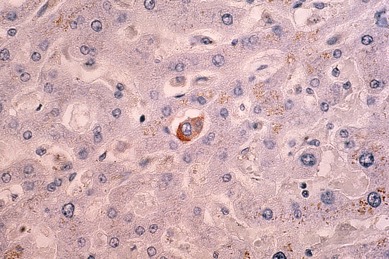 Breast Cancer Metastasis to Liver. Source - National Cancer Institute