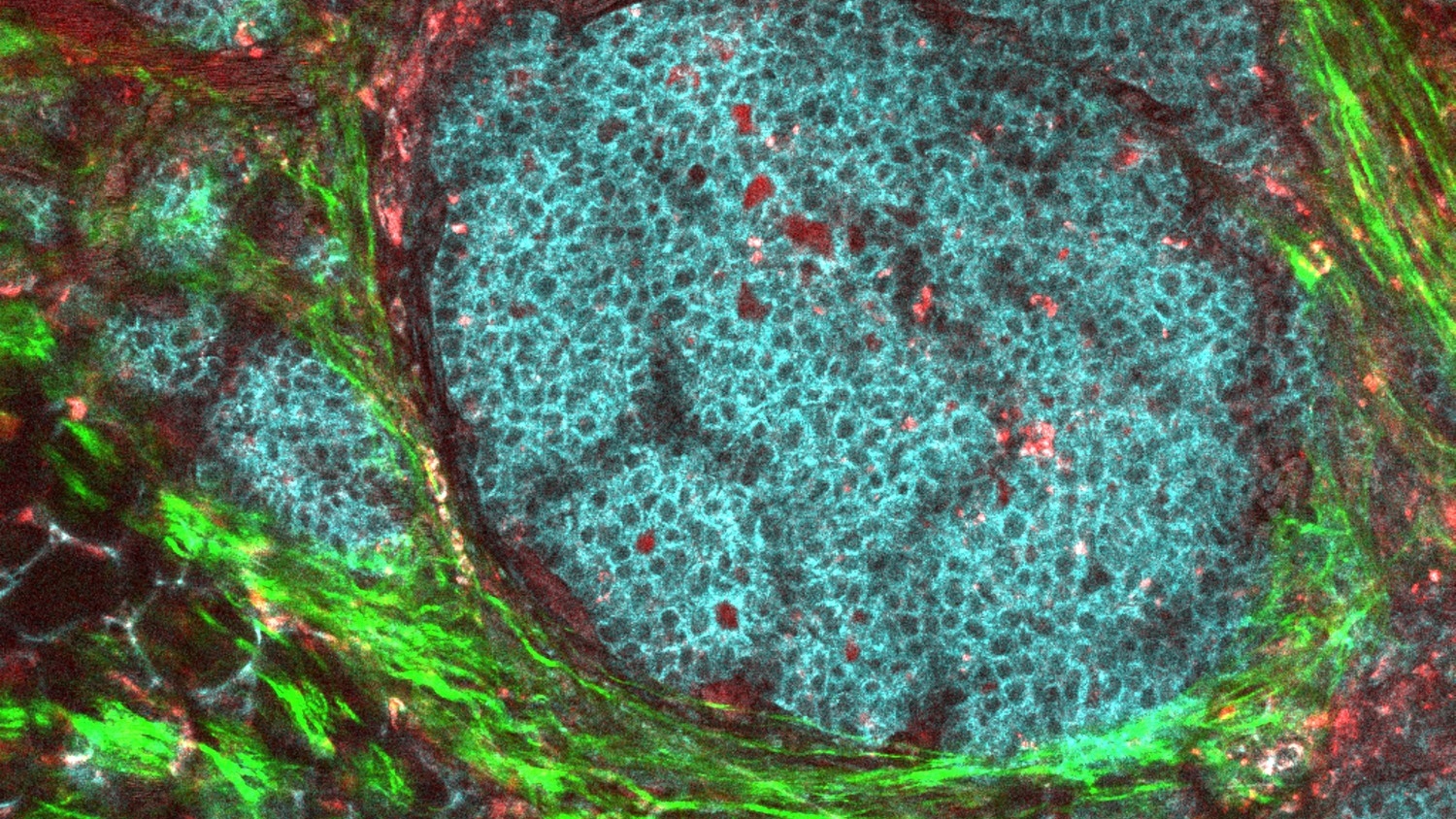 Microscope image of a breast tumour