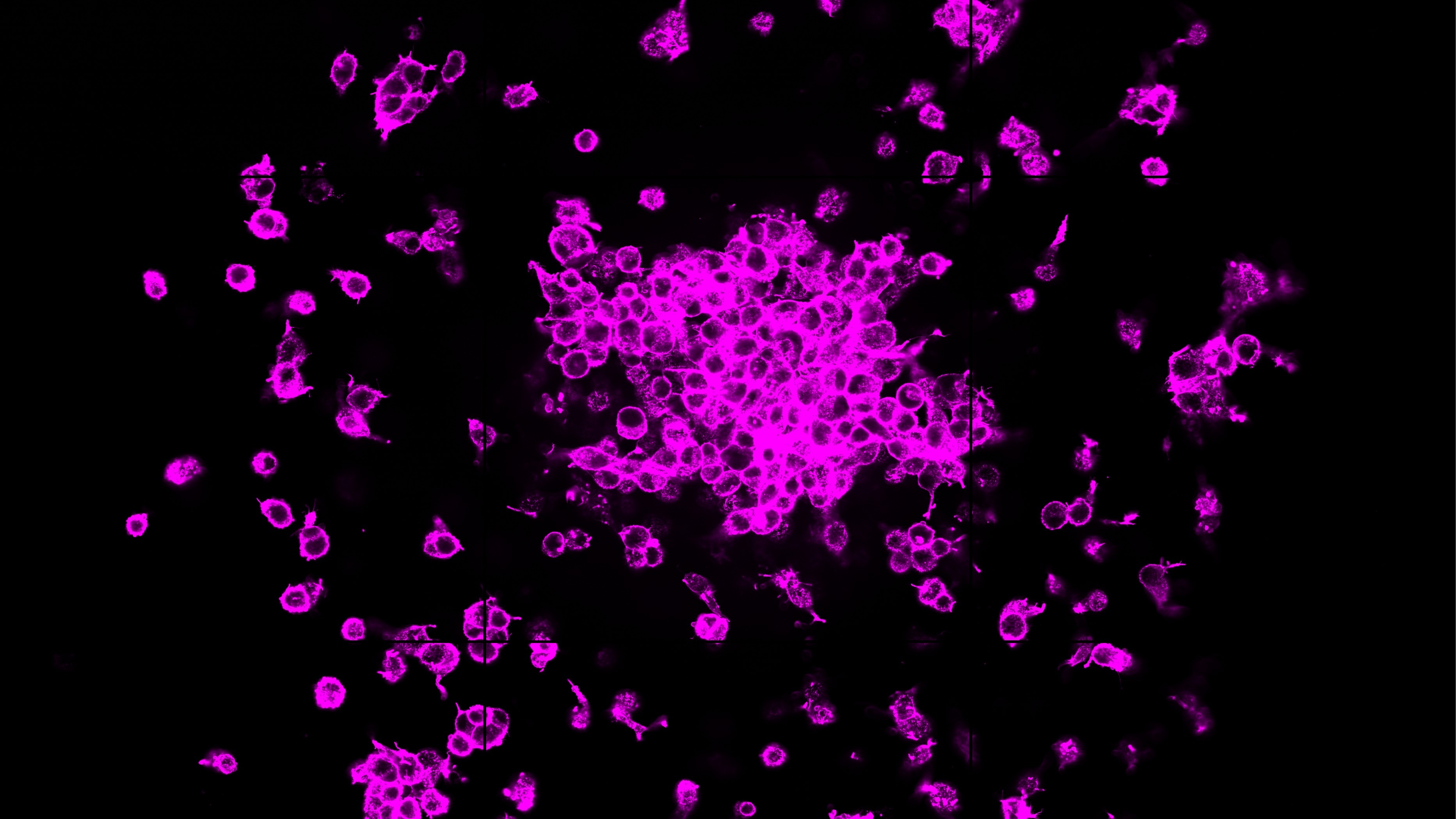 Melanoma Cancer Cell Invasion from Tumour Core in a Collagen I Matrix - Visualization of cancer cell dissemination from the tumour core embedded in a collagen I matrix, highlighting the effect of glutathione treatment on invasive behaviour. Cells in pink are more clustered in the centre of the image, and spread out further away