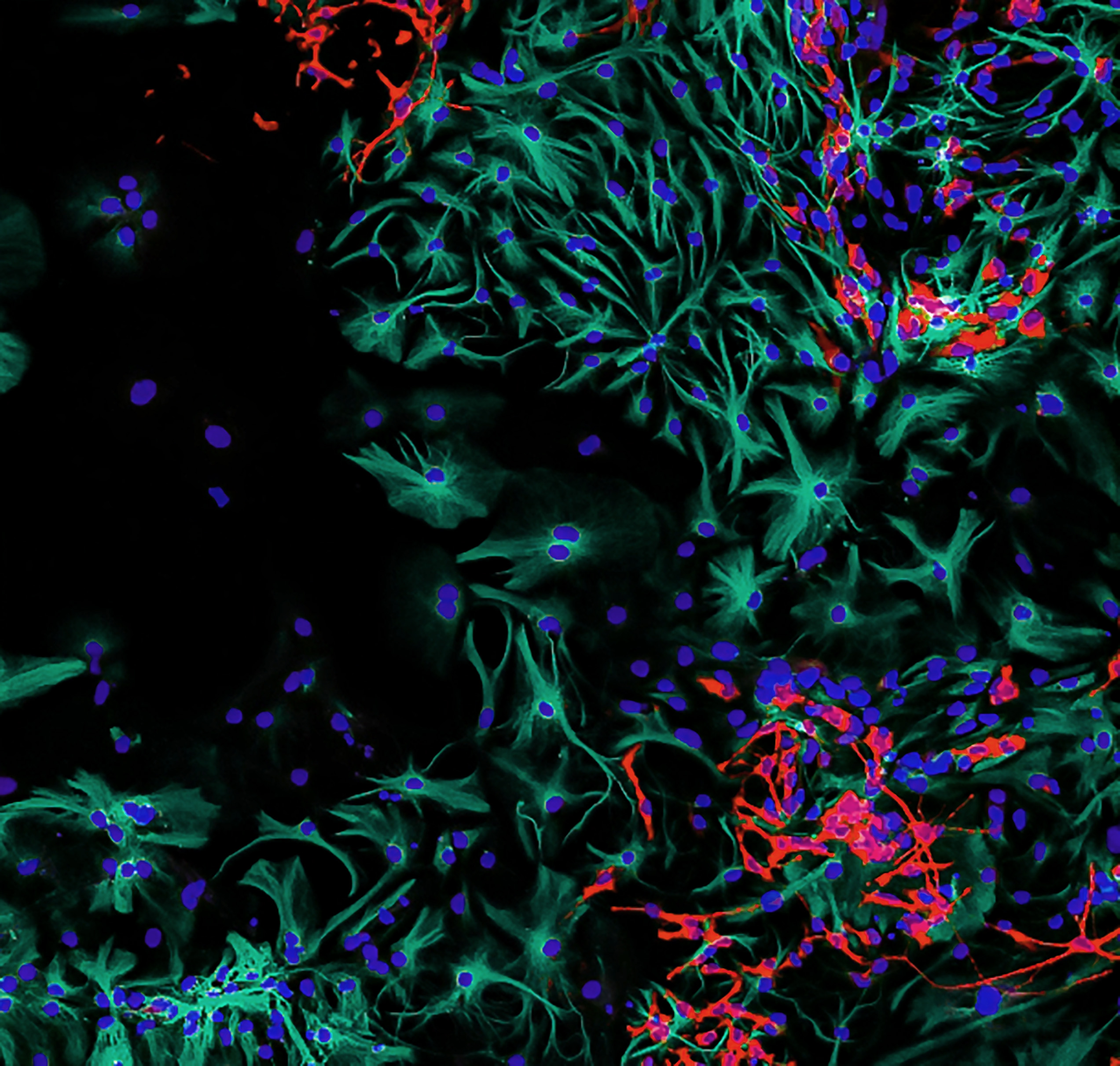 Brain cancer cells image