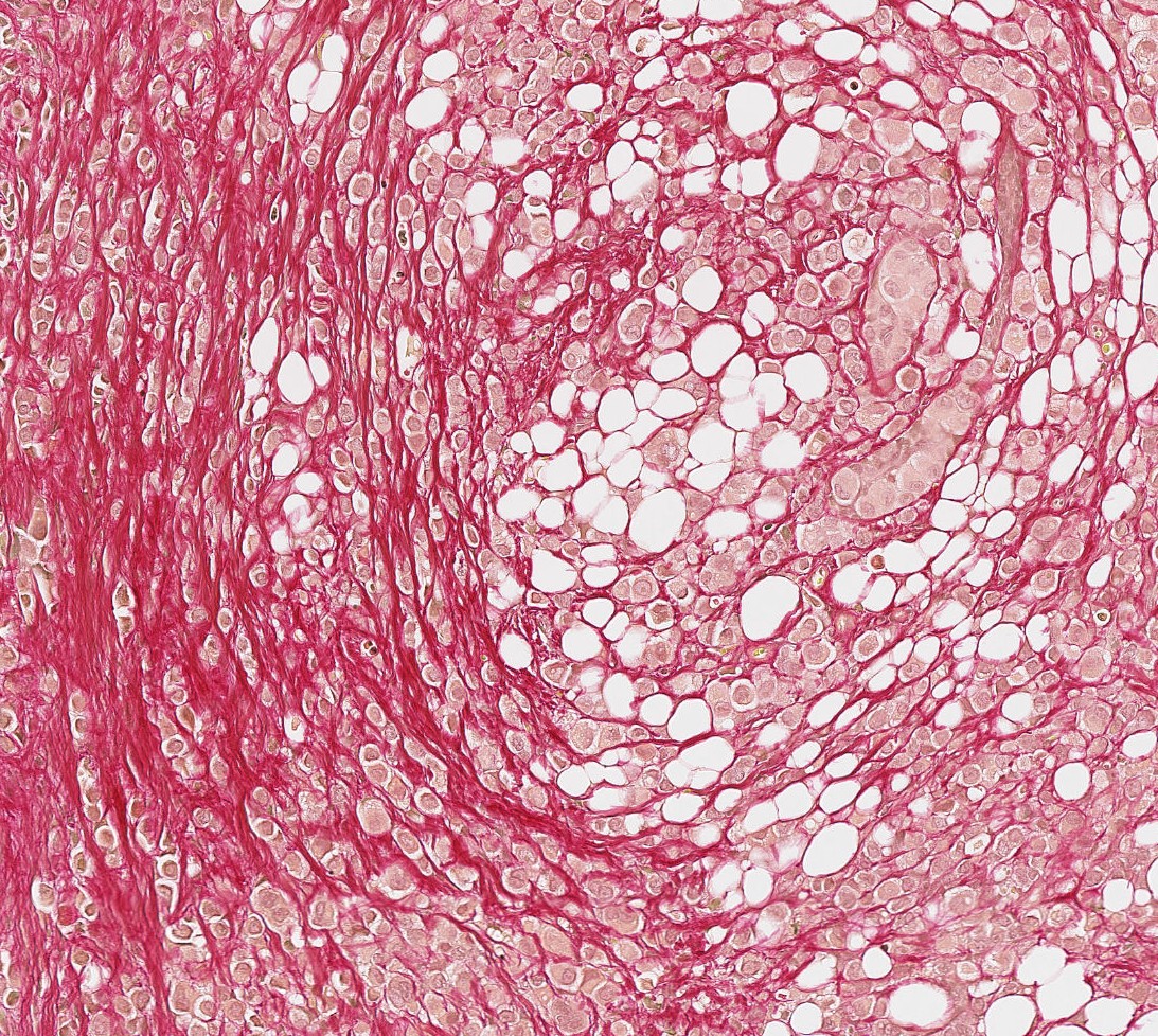 ILC cells (yellow) growing in single files along collagen fibres (red)