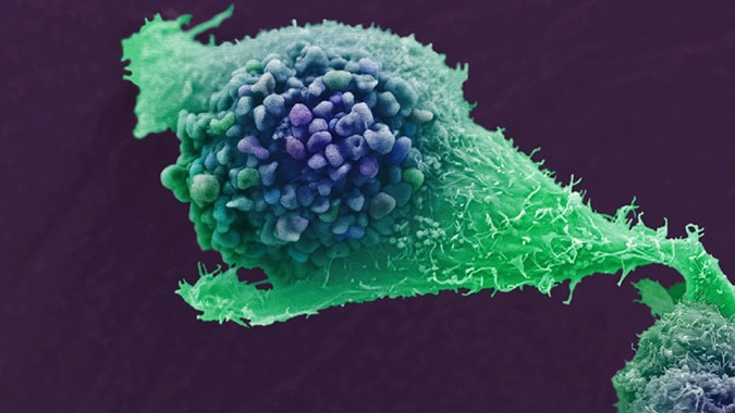 False-coloured scanning electron micrograph of a single prostate cancer cell grown in culture.