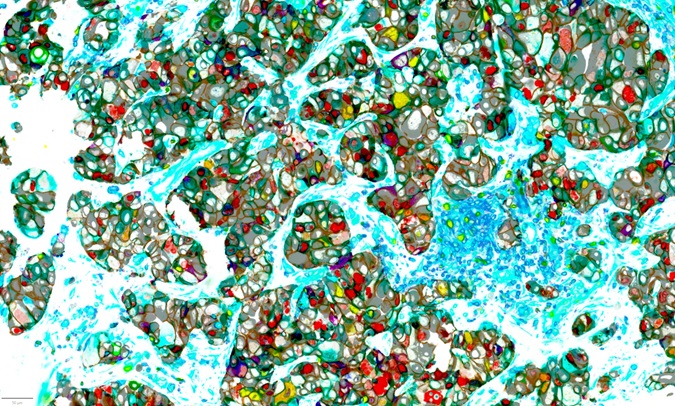 Cancer cells - Mateus Crespo - de Bono Lab 300DPI Science Image Competition 2025