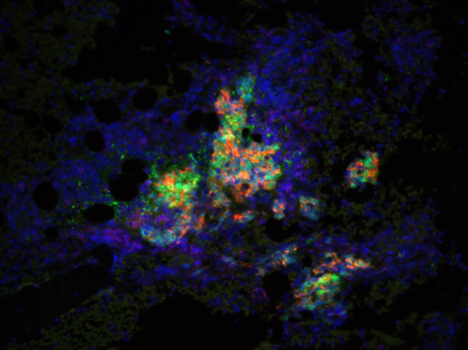 Prostate cancer cells