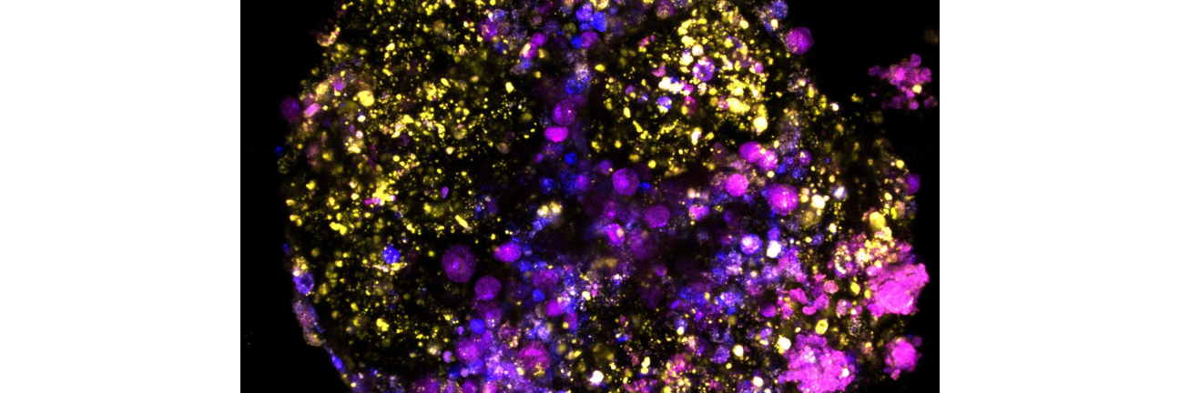 Bowel tumour organoids
