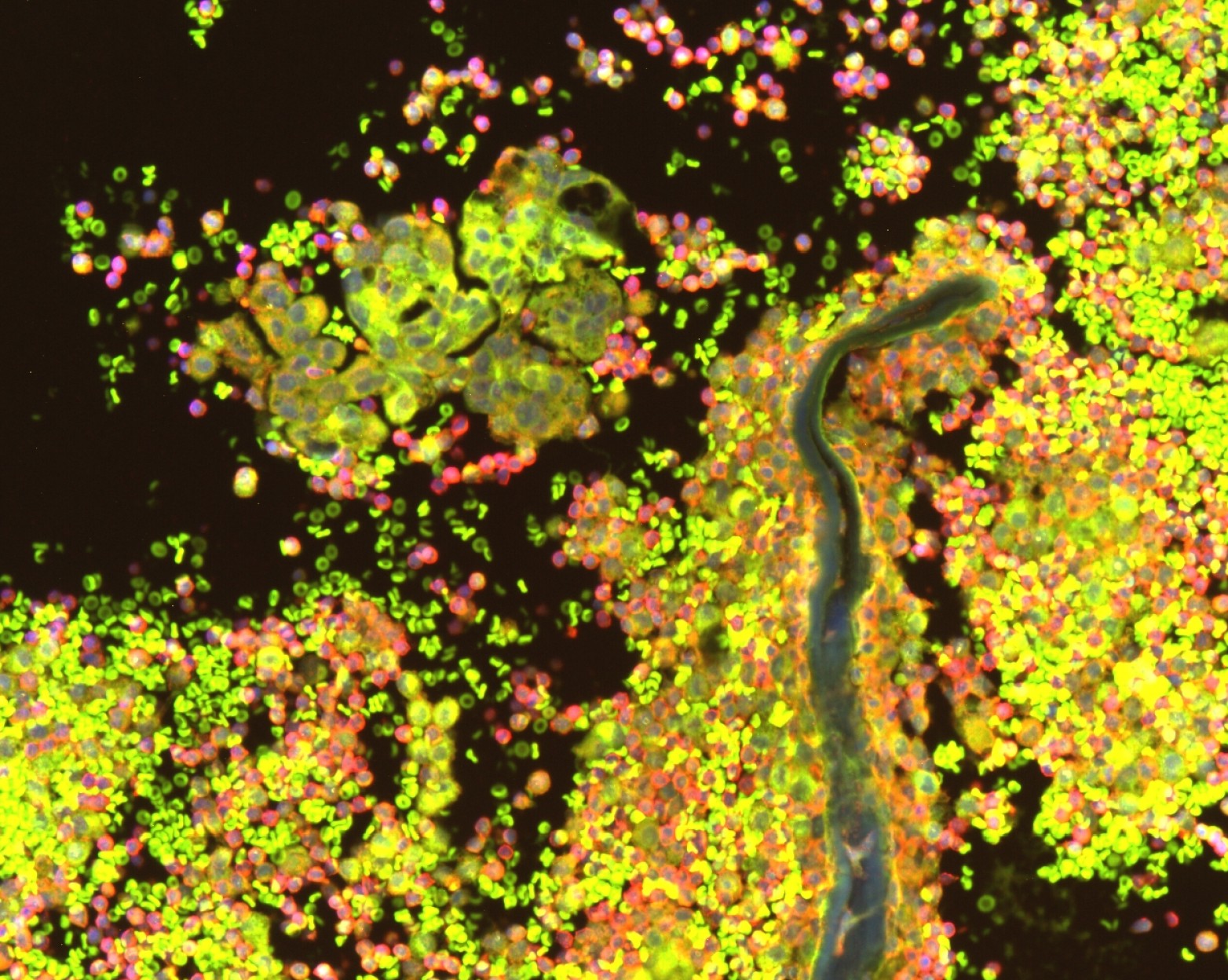 Microscope image of cancerous cells