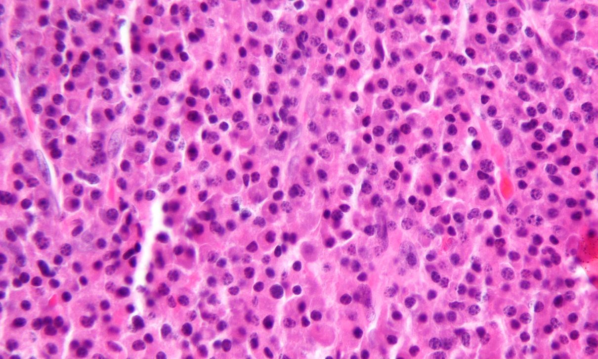 Microscope image of H&E stain of myeloma