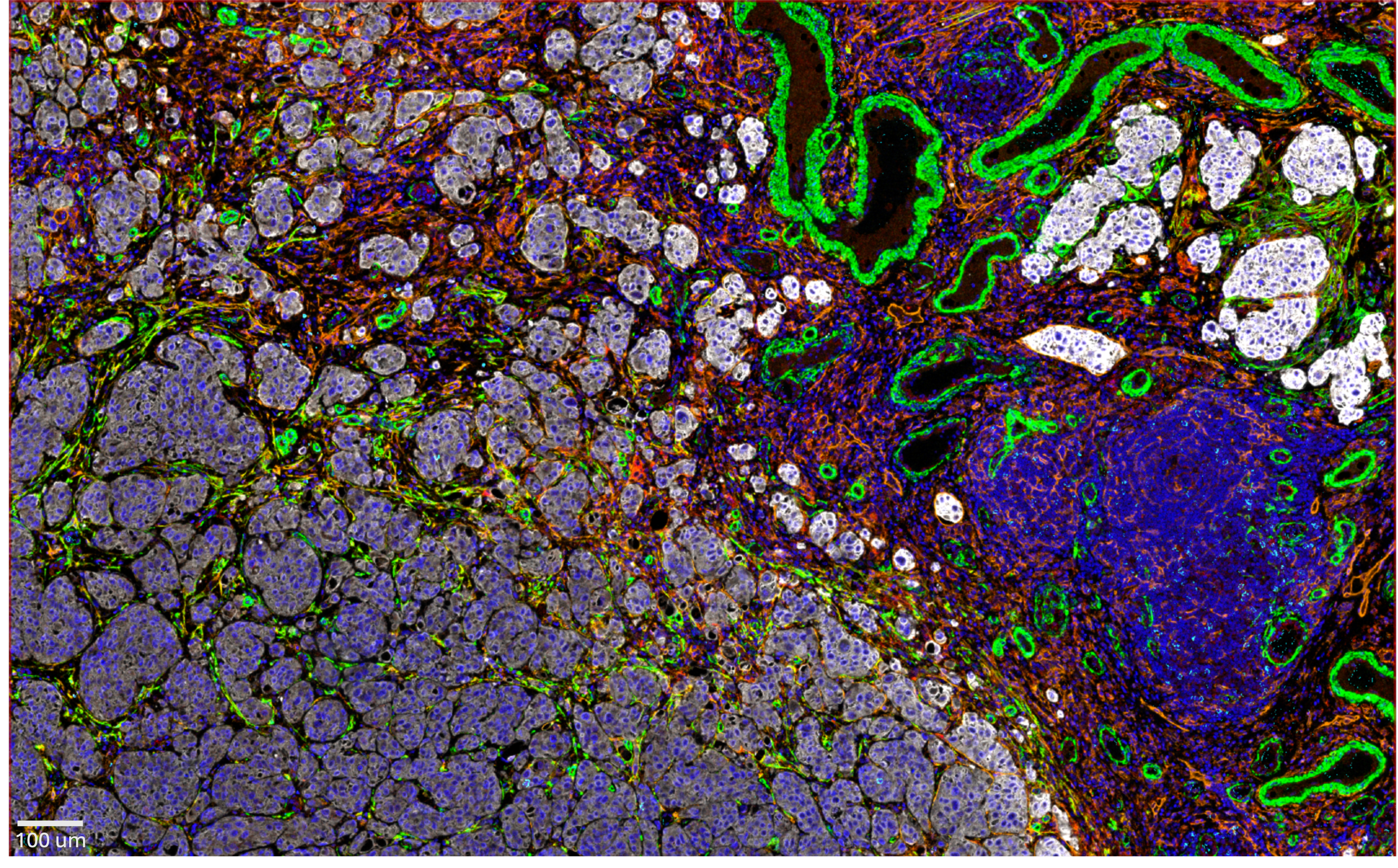 Microscope image of bladder tumour microenvironment
