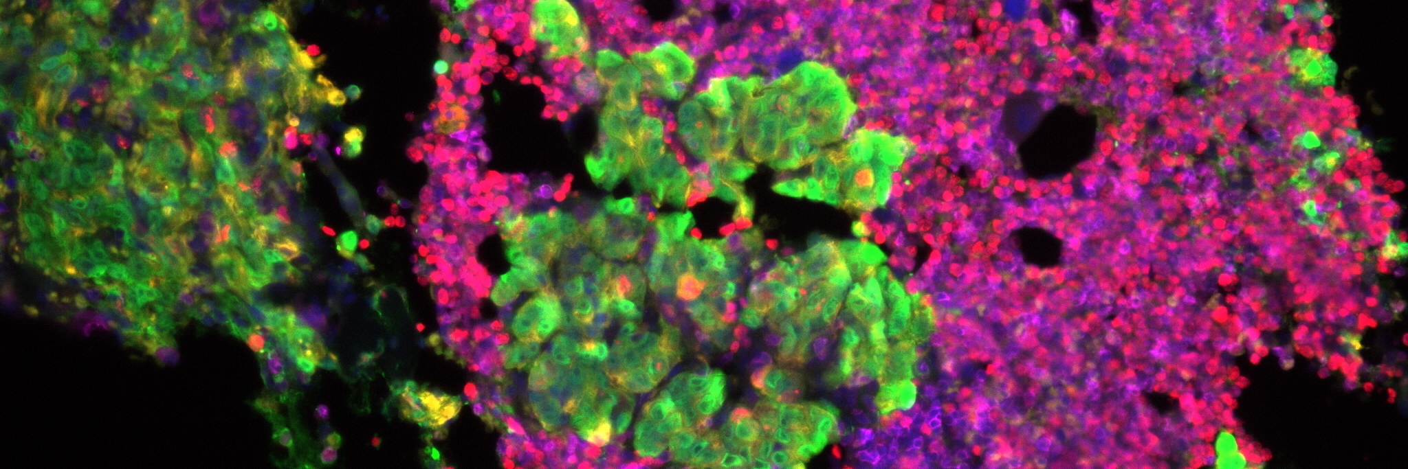 Microscope image of a tumour twh Microscope image of a tumour