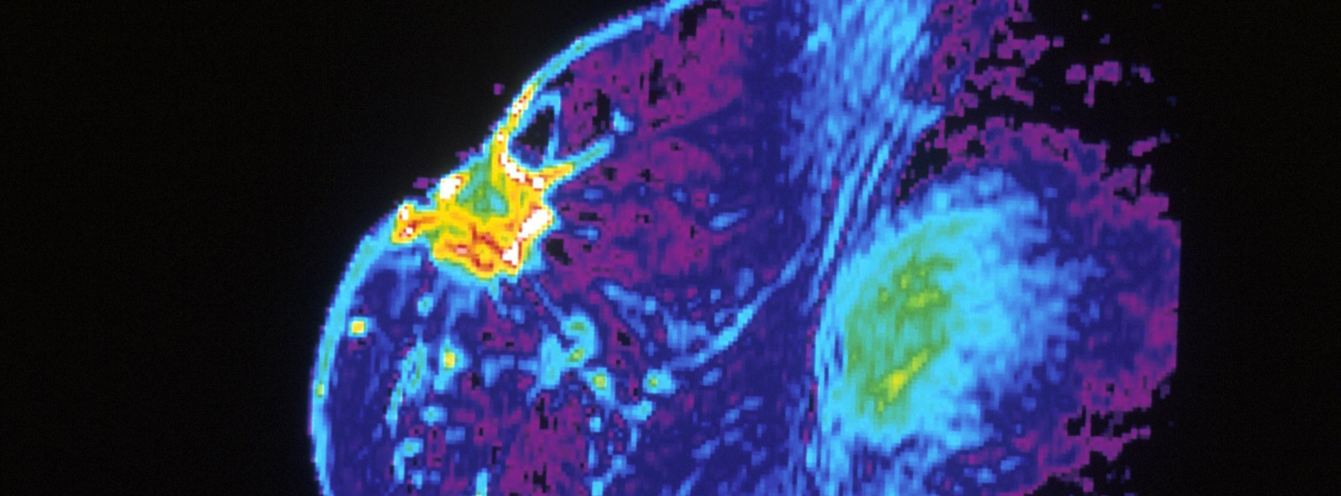 MRI scan of a breast tumour