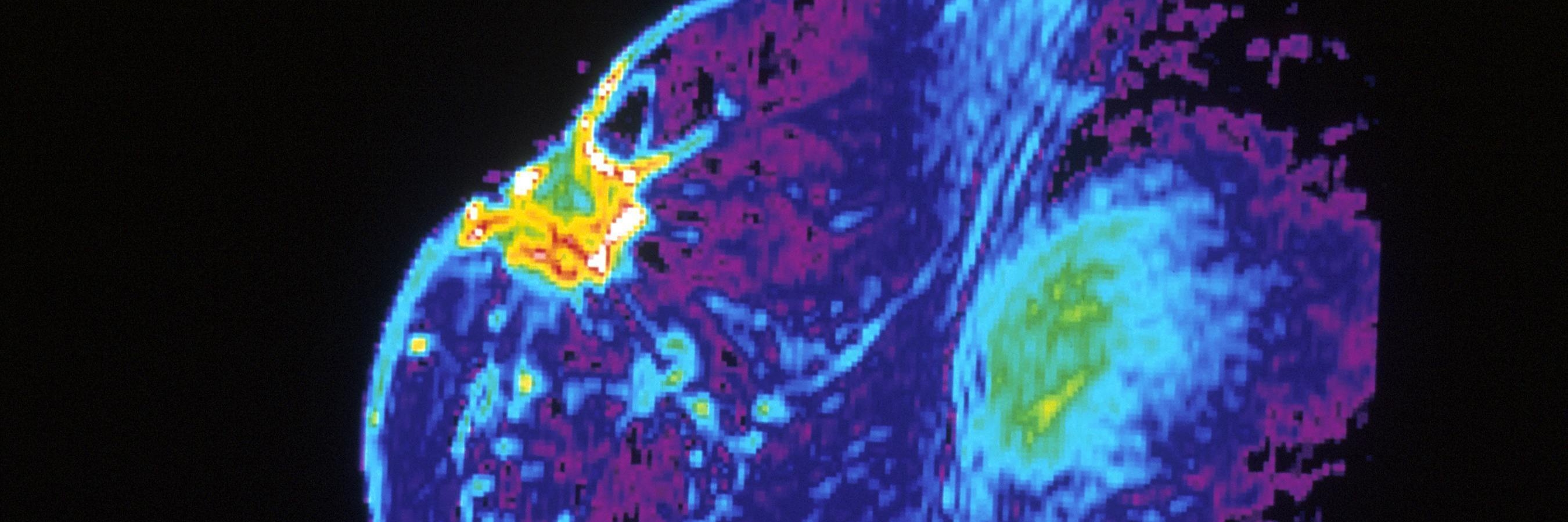 mri-of-breast twh MRI of a breast