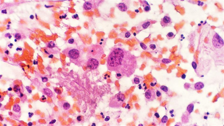 Microscope image of myeloma