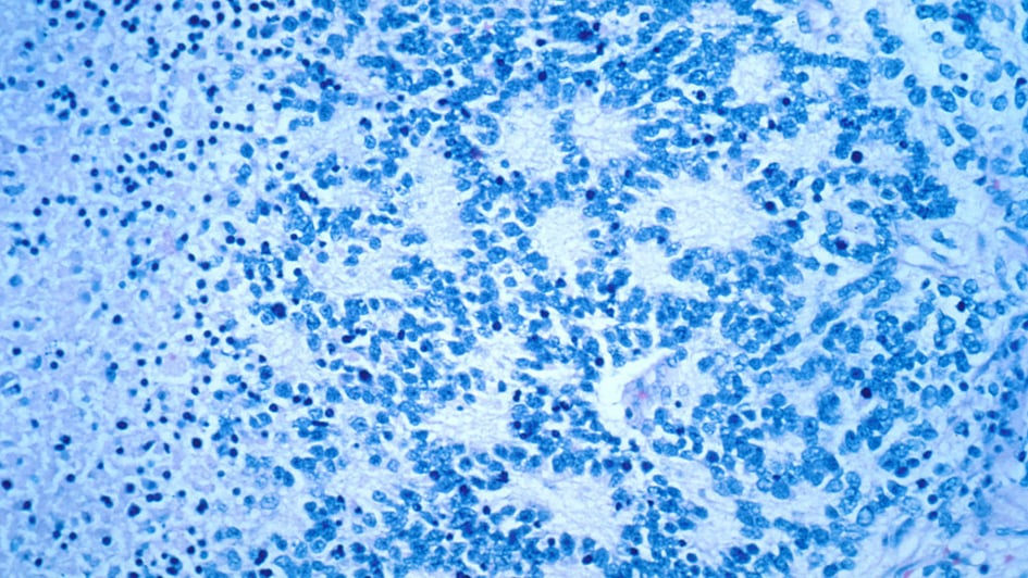 Microscope image of neuroblastoma, stained blue