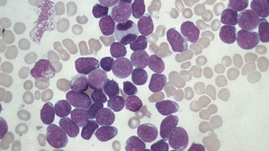 Acute lymphoblastic leukaemia