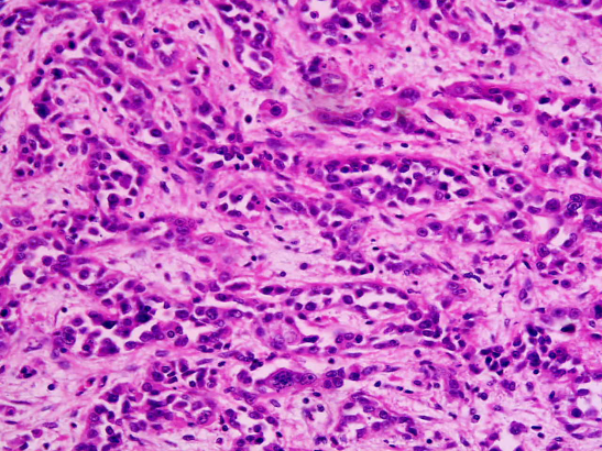 Adenocarcinoma Stomach Cancer Wikipedia Adenocarcinoma Stomach Cancer Wikipedia
