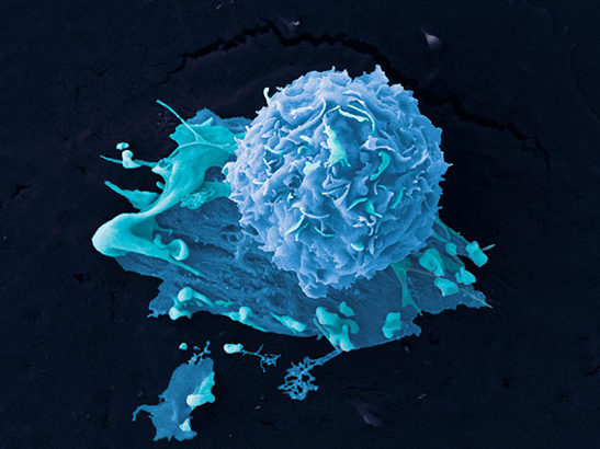 Colour-enhanced image of breast cancer cells 547x410px Colour-enhanced image of breast cancer cells