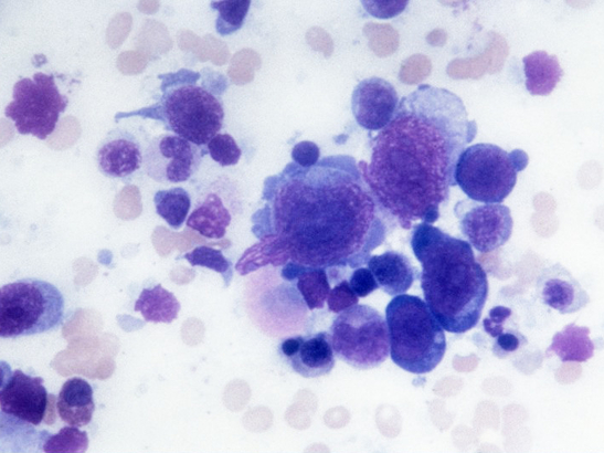 Hodgkin lymphoma cells 547x410 Hodgkin lymphoma cells