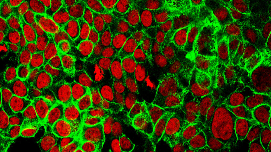 Human Colon Cancer Cells - bowel cancer 945x532 Human colon cancer cells with the cell nuclei stained red and the protein E-cadherin stained green.