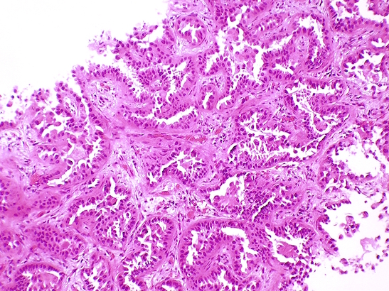 lung adenocarcinoma 547x410 Biopsy of lung adenocarcinoma tissue