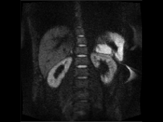 Median vs Mean DW MRI Median vs Mean DW MRI