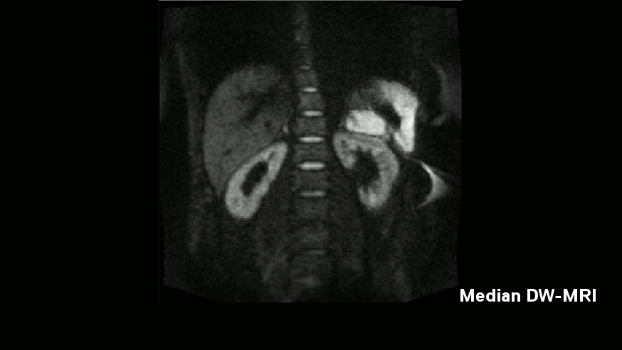 Median vs Mean DW-MRI Comparison between Median and Mean calculated Diffusion Weighted MRI Image