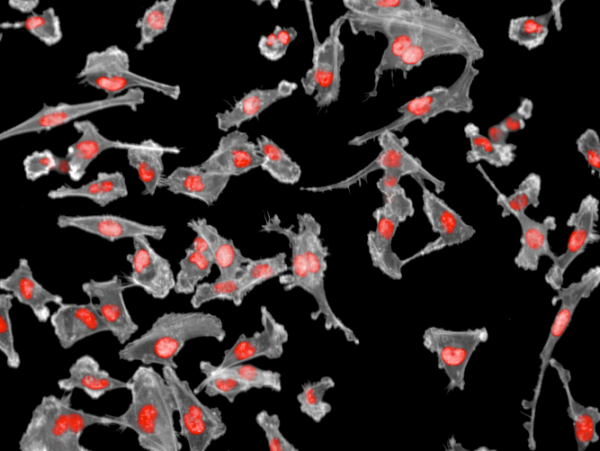 Metastatic breast cancer cells showing loss of healthy cell structure