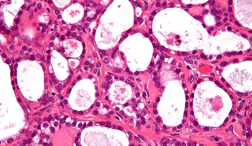 Ovarian clear cell carcinoma high mag embed photo: Nephron 846x492 A high magnification image of ovarian clear cell carcinoma