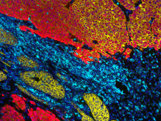 Prostate Cancer Rosetta Stone 547x410 Prostate Cancer Rosetta Stone (Mateus Crespo/Prof Johann de Bono, the ICR)