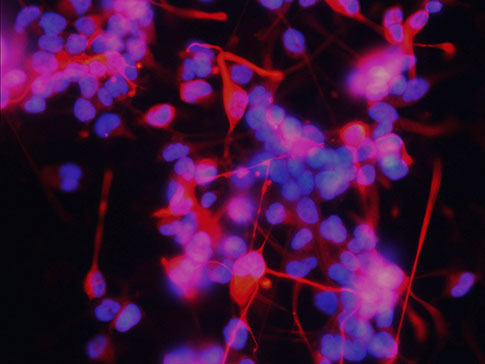 DIPG cells_485x364 DIPG cells_485x364