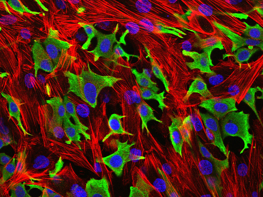 Breast cancer Cells invading through fibrobalsts Breast cancer cells (green) invading through a layer of fibroblasts (red). (Luke Henry / the ICR, 2009)