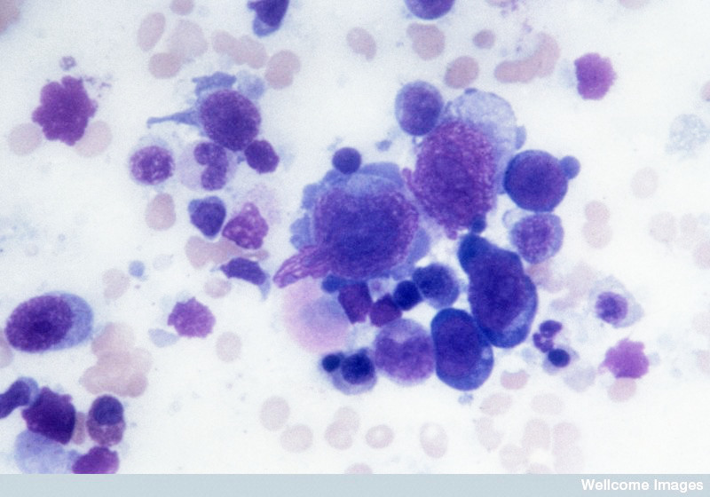 Hodgkin Lymphoma. Wellcome Images / Creative Commons by-nc-nd 4.0 Hodgkin Lymphoma. Wellcome Images / Creative Commons by-nc-nd 4.0