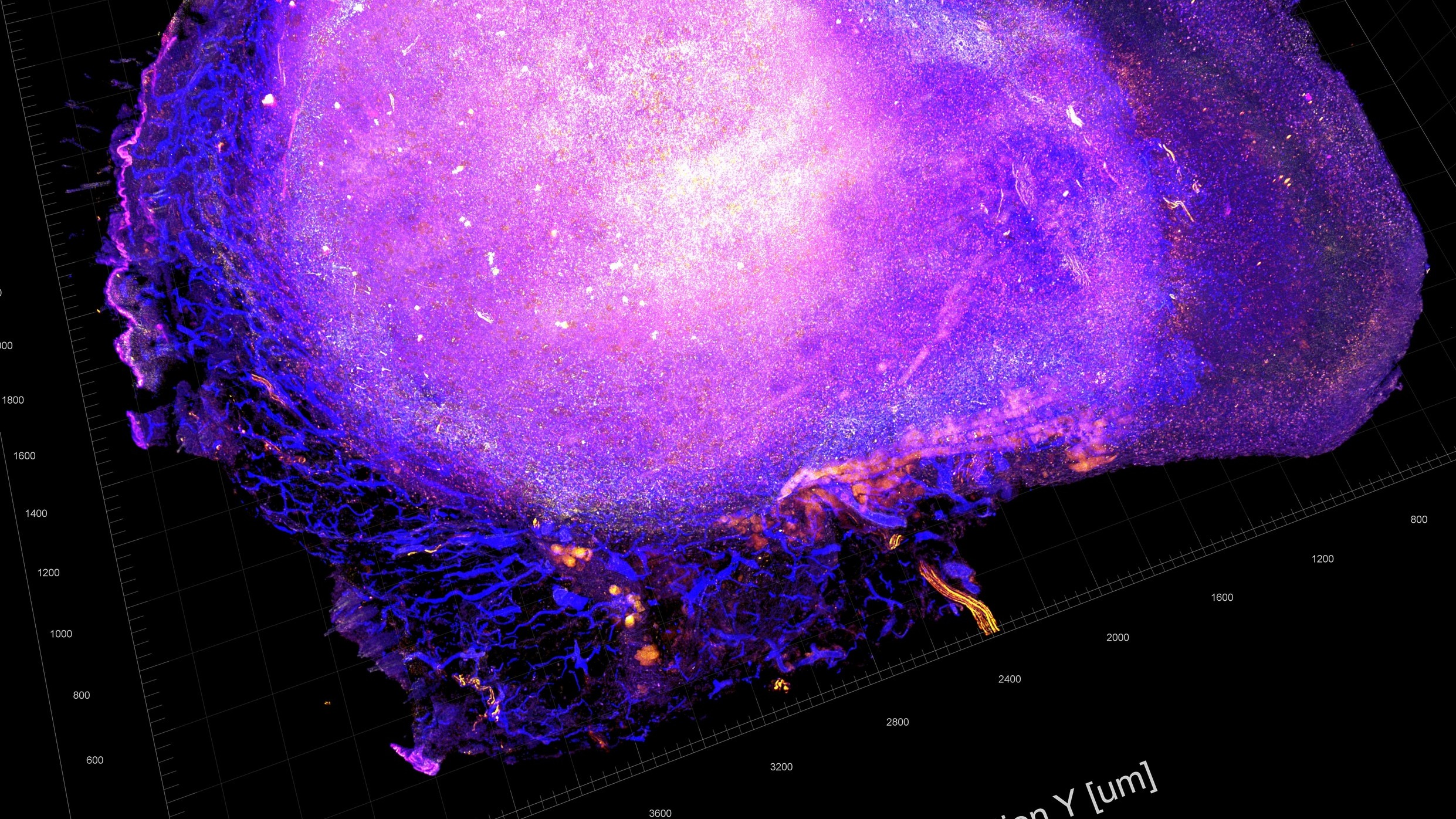 Anti-Tumor Immune Response. Source: National Cancer Institute \ Univ. of Chicago Comprehensive Cancer Center Microscope image of an anti-Tumour Immune Response