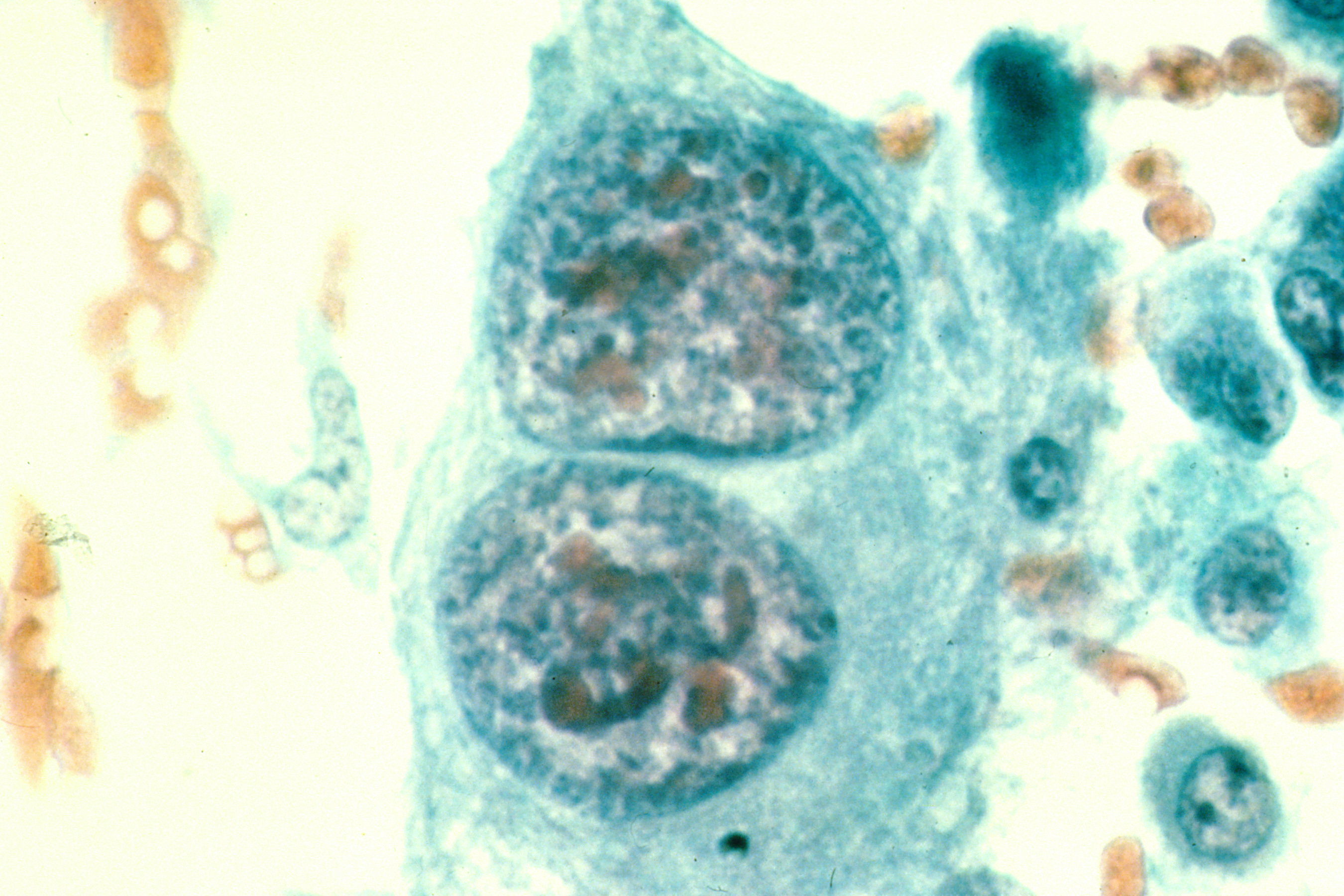 Human malignant osteosarcoma (bone cancer) cells